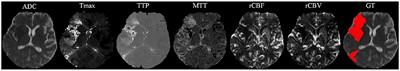 Stroke Lesion Outcome Prediction Based on MRI Imaging Combined With Clinical Information